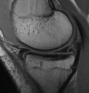 MRI Meniscus Tear Posterior Horn